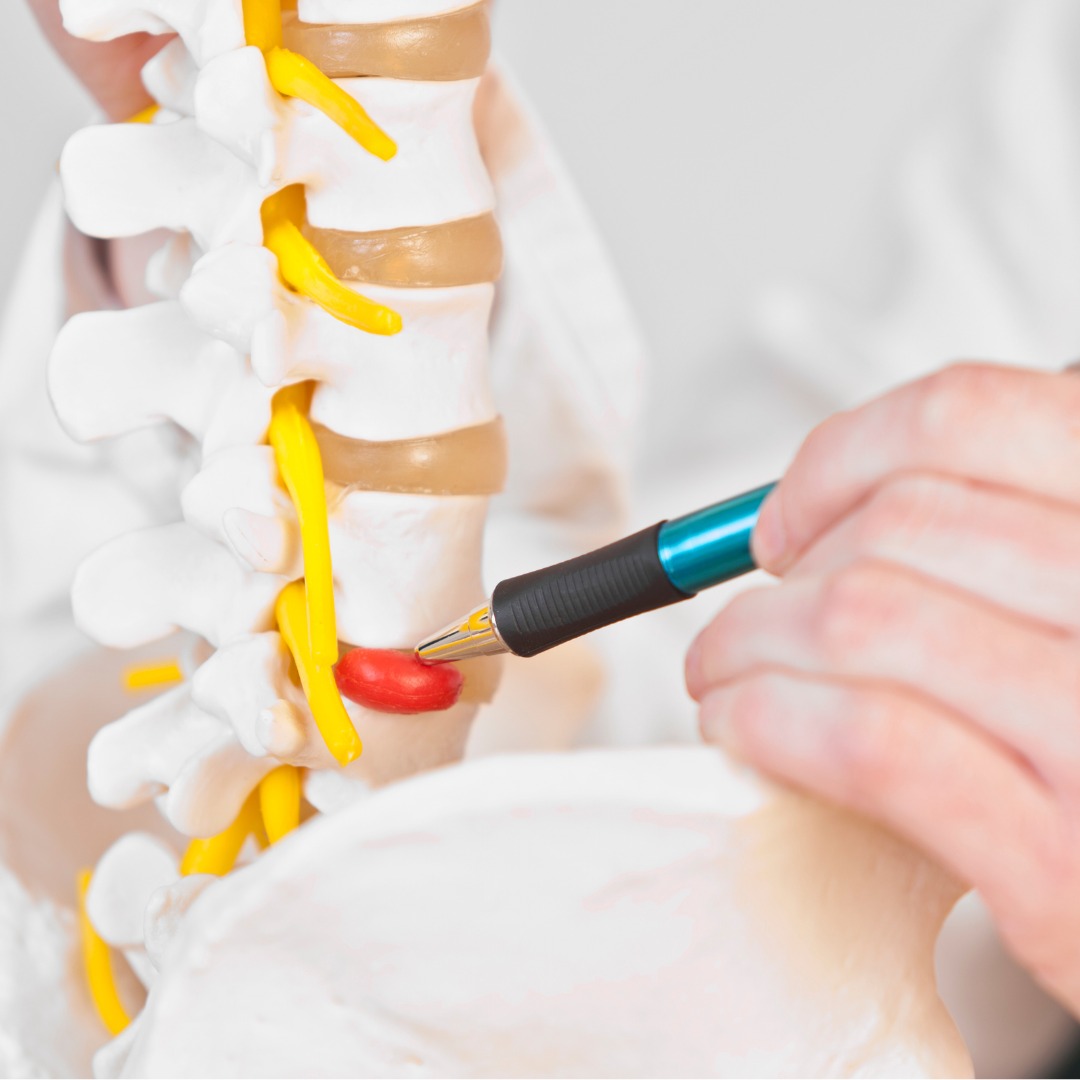 Slip Disc Treatment